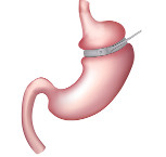 Stomach graphic with a band tightened around the top